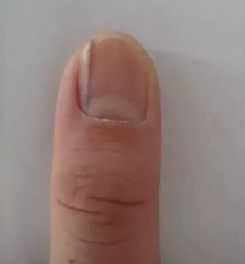 天天盈 别忽视！指甲异样，竟可能是疾病征兆？